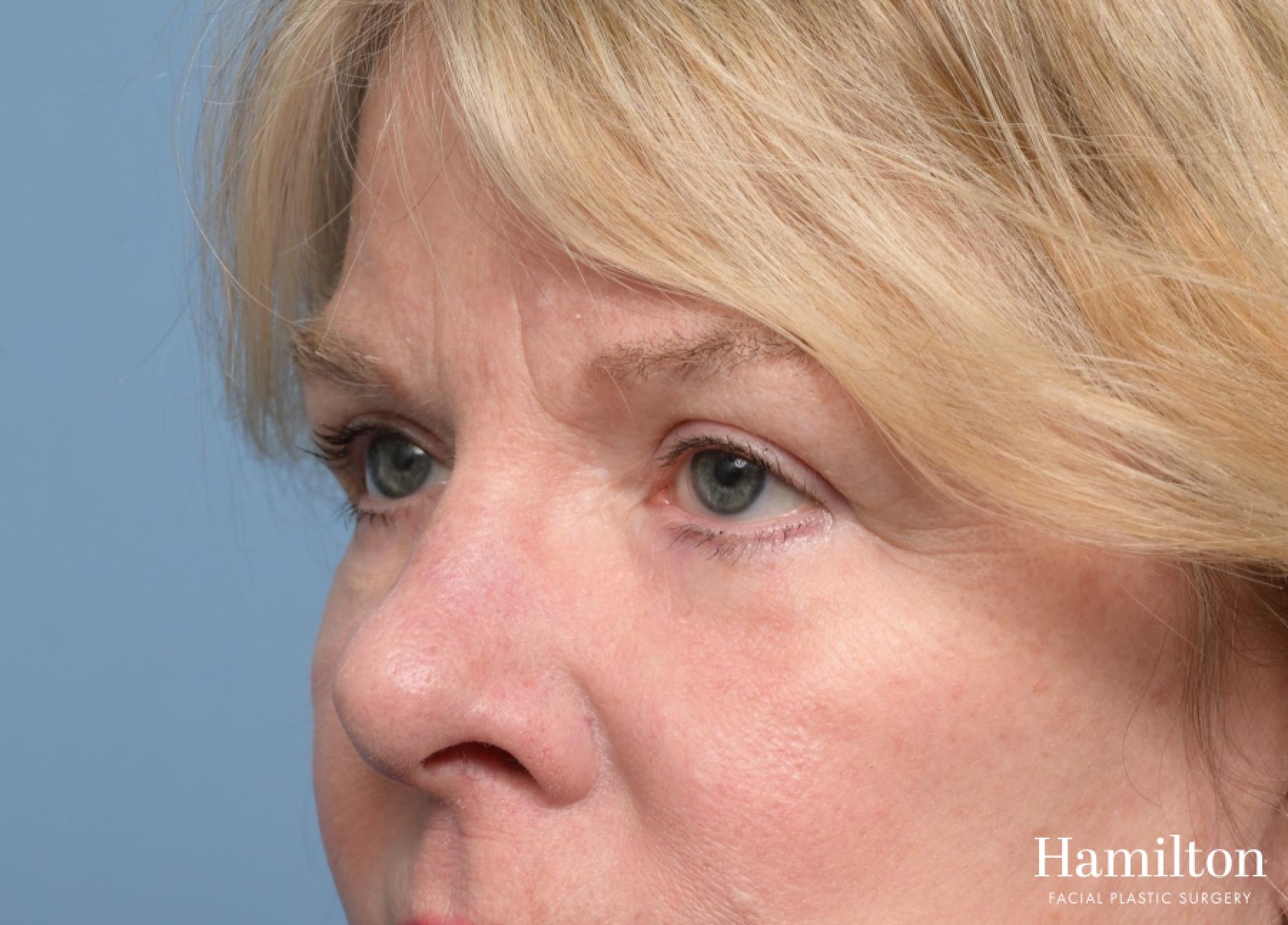 Blepharoplasty: Patient 11 - After 3