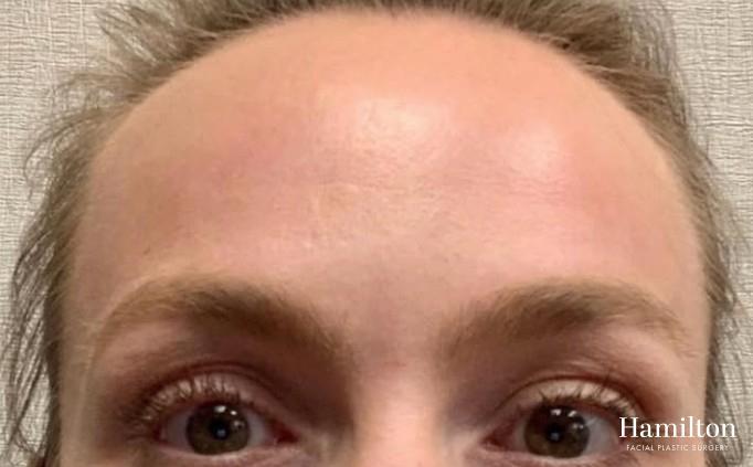 Neurotoxins/Botox: Patient 7 - After 1