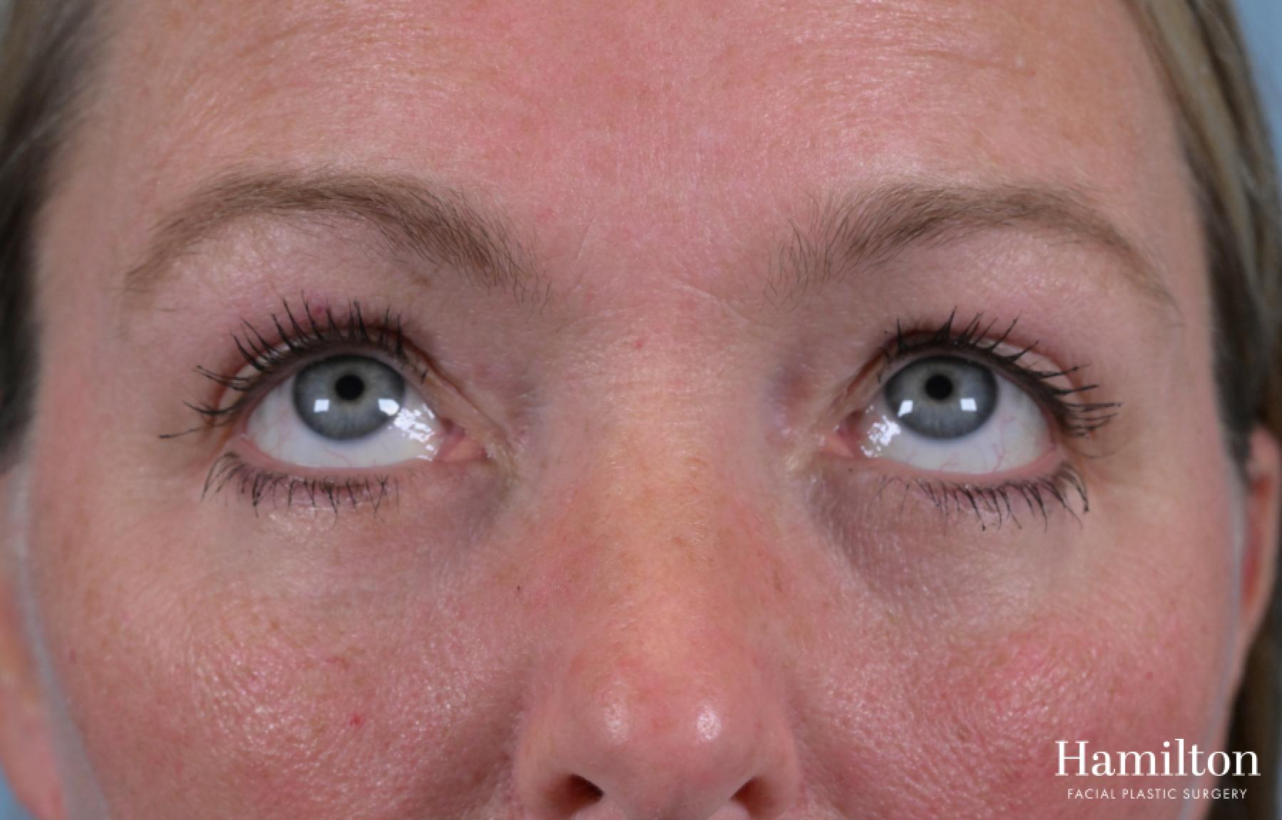 Blepharoplasty: Patient 2 - After 2