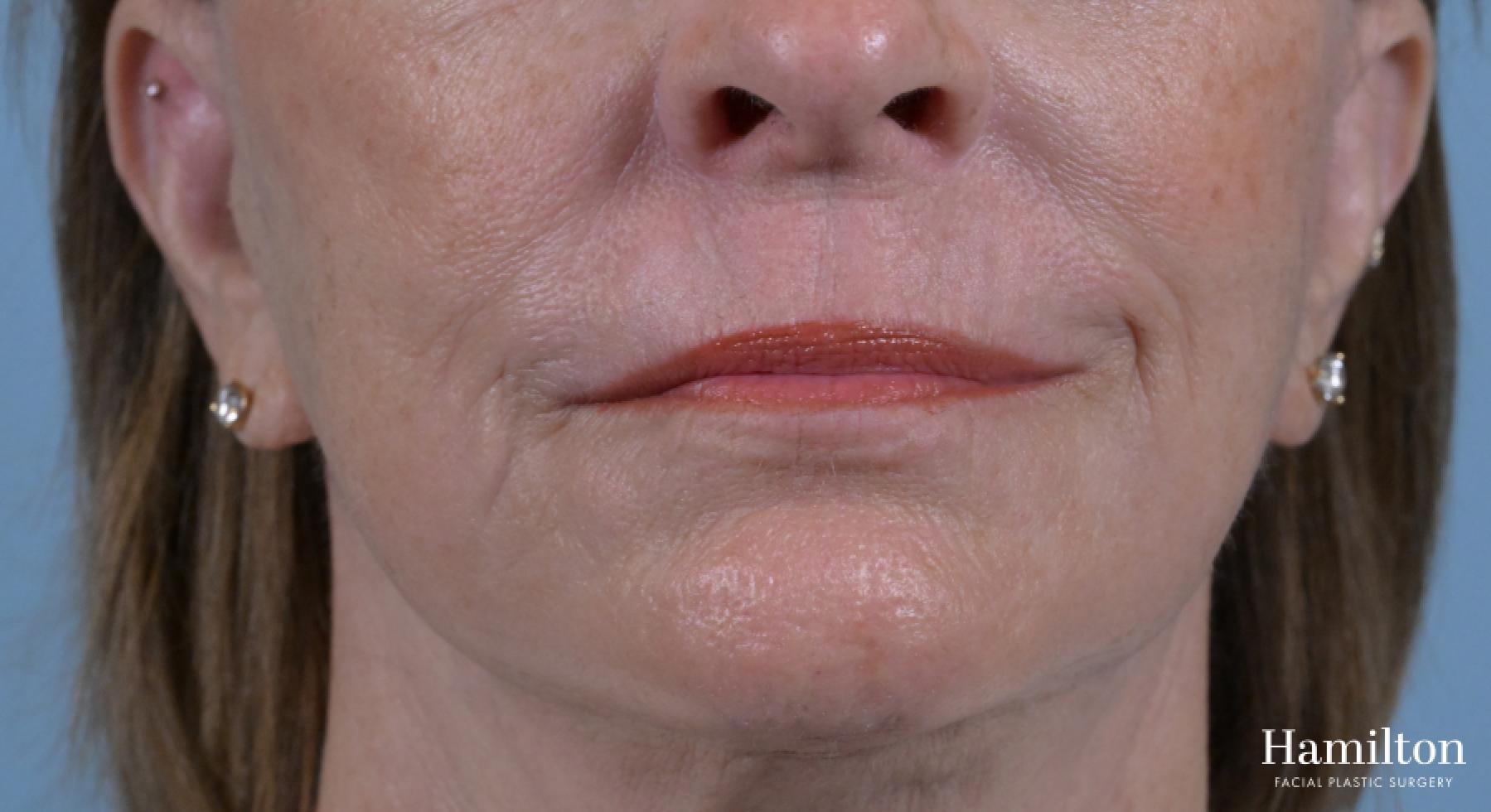 Sciton Laser: Patient 2 - After 2