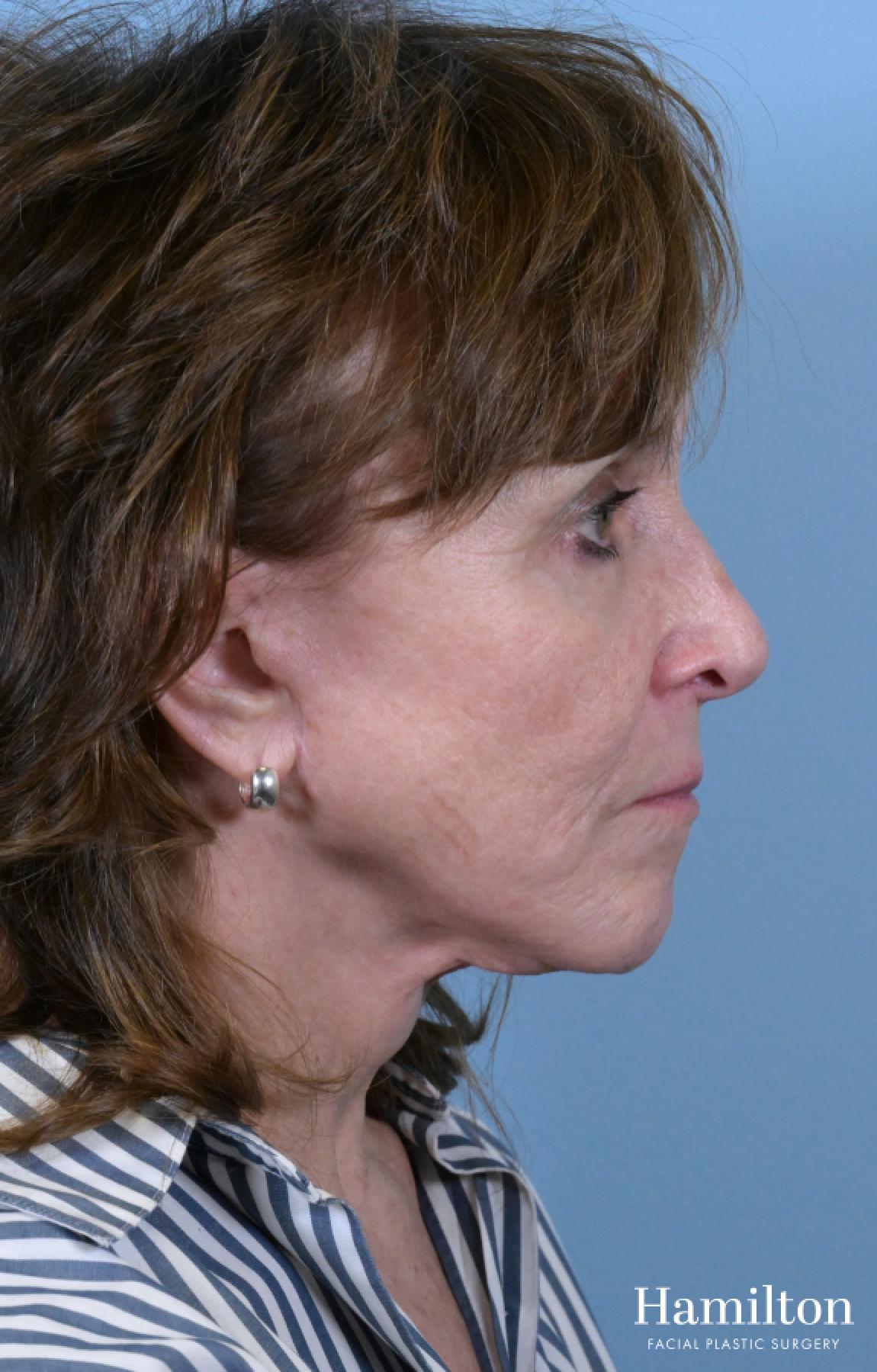 Facelift: Patient 40 - After 4