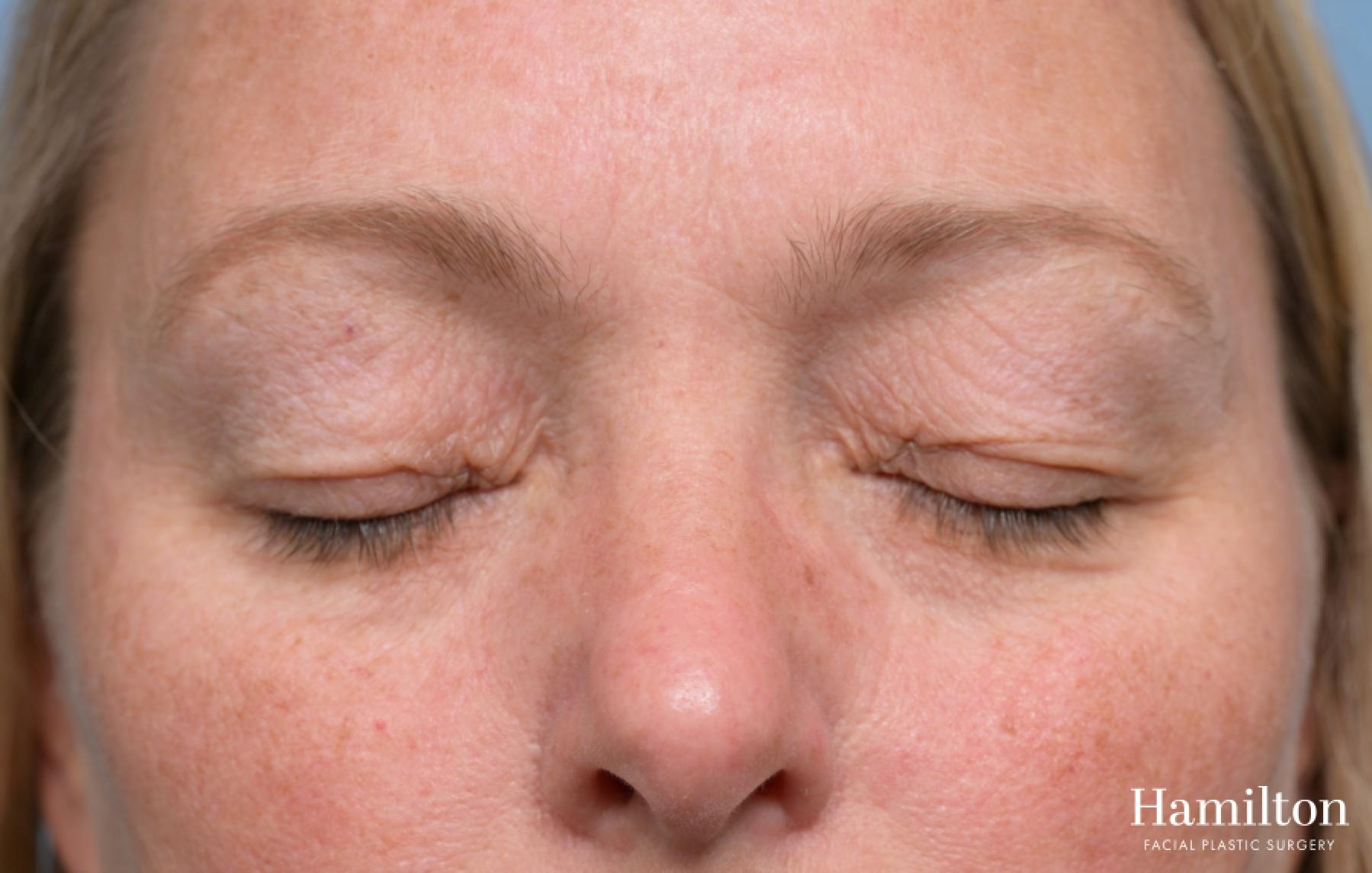 Blepharoplasty: Patient 2 - Before and After 7