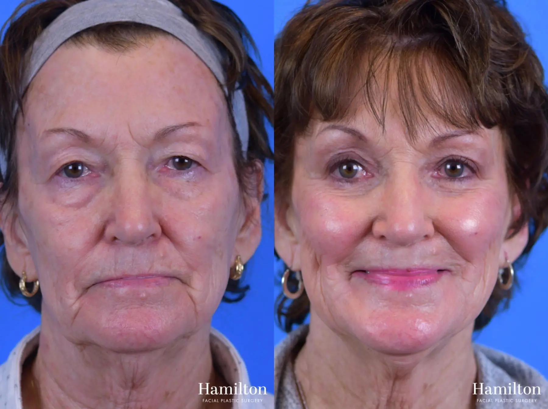 Blepharoplasty: Patient 8 - Before and After 4