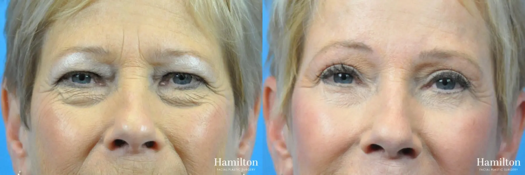 Blepharoplasty: Patient 2 - Before and After  