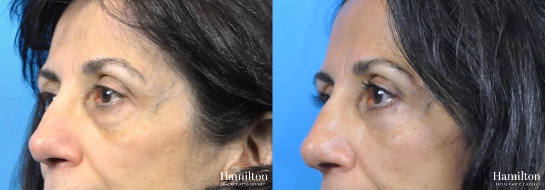 Blepharoplasty: Patient 19 - Before and After 2