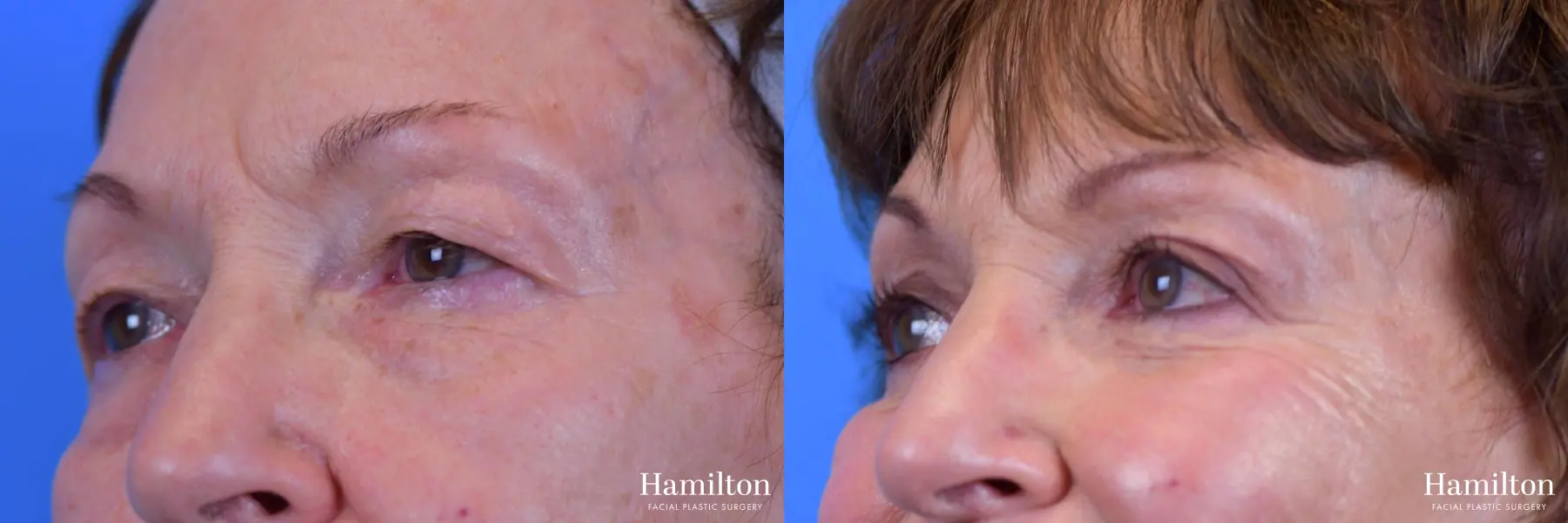 Blepharoplasty: Patient 8 - Before and After  