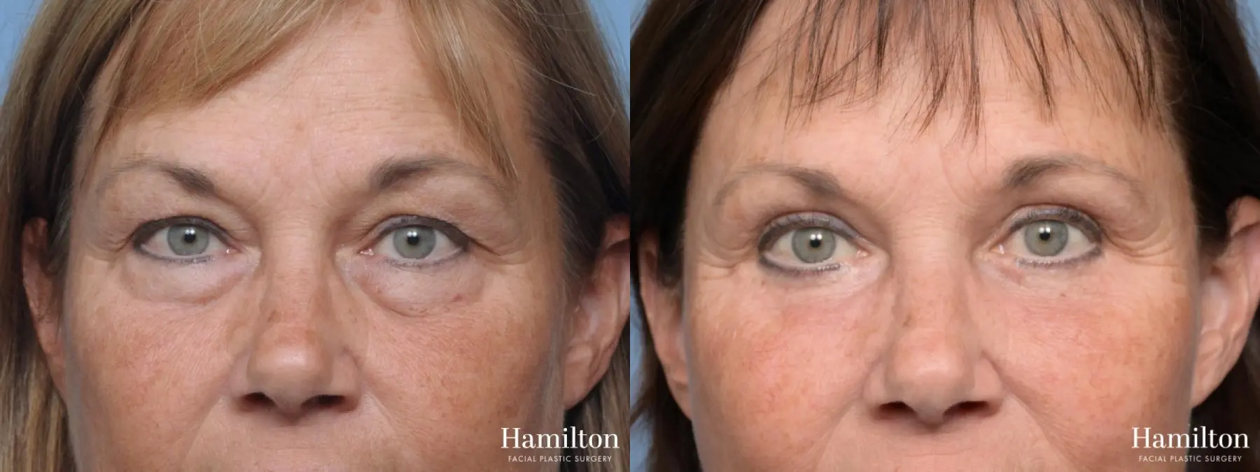 Blepharoplasty: Patient 12 - Before and After