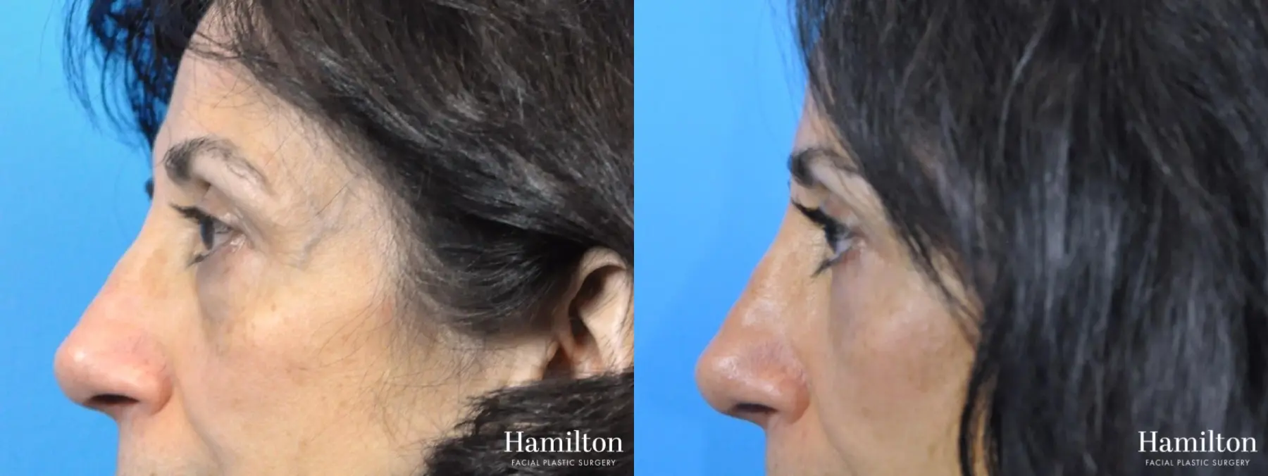 Blepharoplasty: Patient 19 - Before and After 4