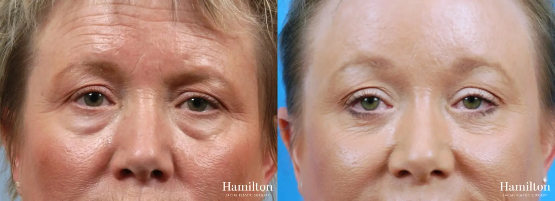 Blepharoplasty: Patient 26 - Before and After 1