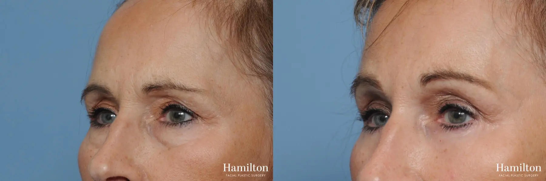 Blepharoplasty: Patient 7 - Before and After 1