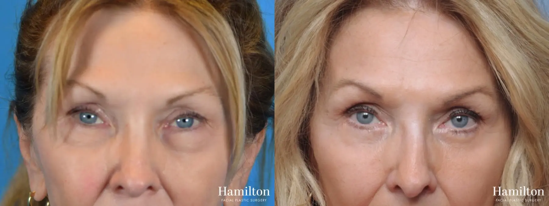 Blepharoplasty: Patient 3 - Before and After 2