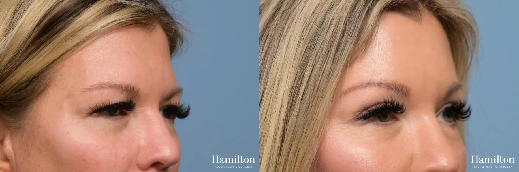 Blepharoplasty: Patient 4 - Before and After 2