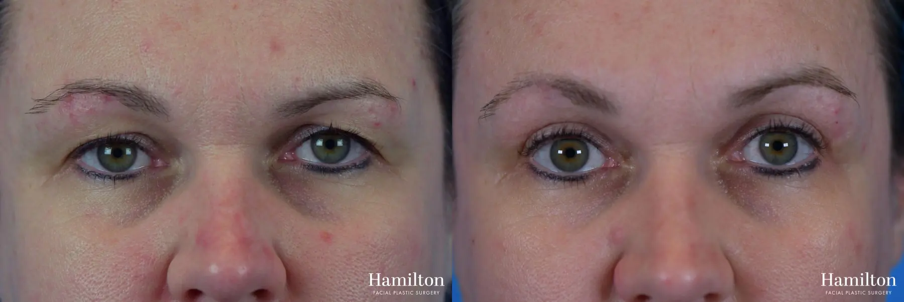 Blepharoplasty: Patient 16 - Before and After 1