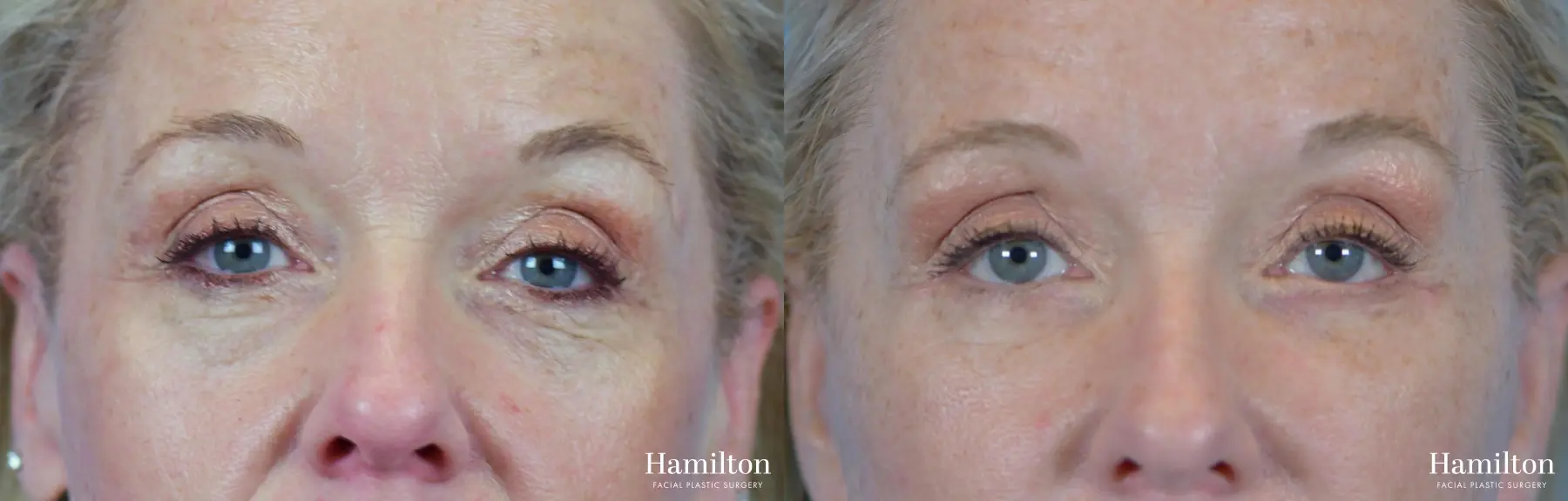 Blepharoplasty: Patient 15 - Before and After