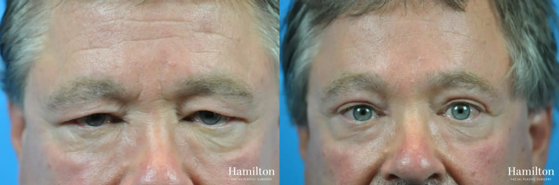 Blepharoplasty: Patient 17 - Before and After 3