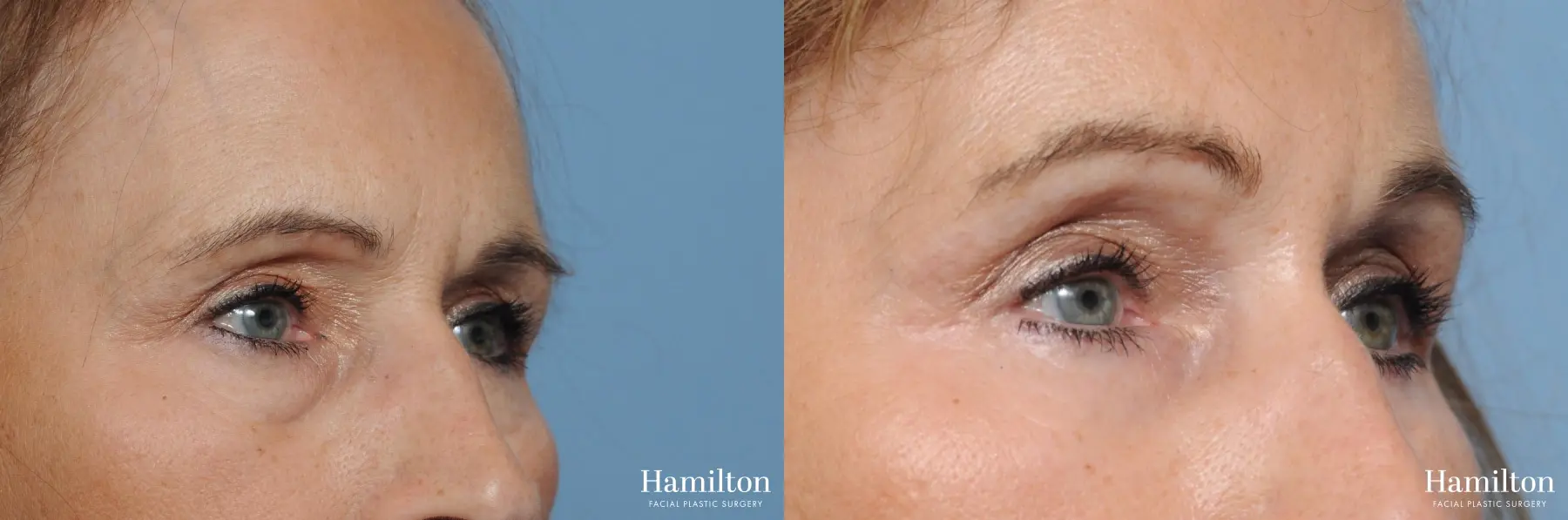 Blepharoplasty: Patient 7 - Before and After 3