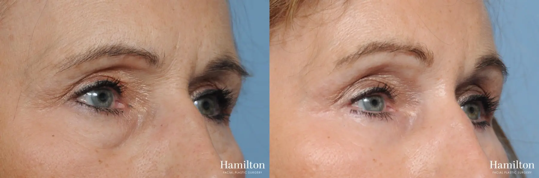 Blepharoplasty: Patient 7 - Before and After 3