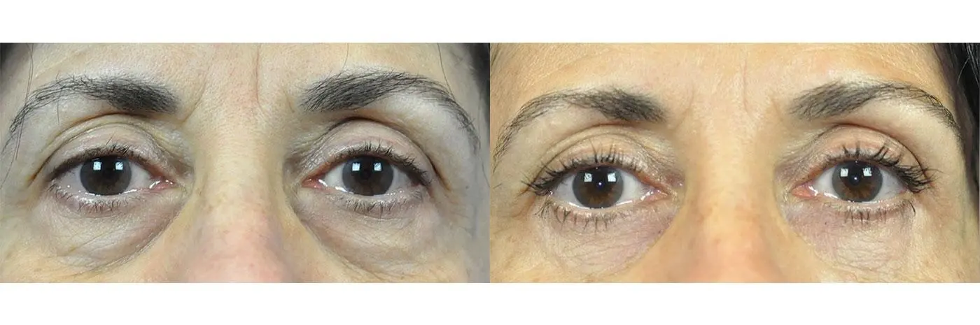 Blepharoplasty: Patient 10 - Before and After 1