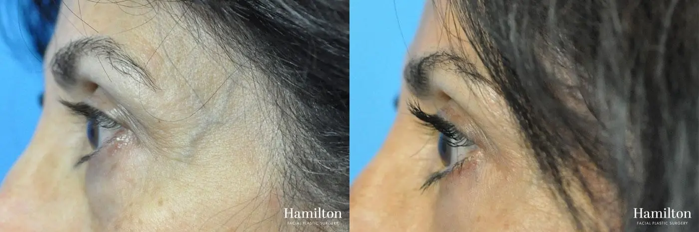 Blepharoplasty: Patient 10 - Before and After 3