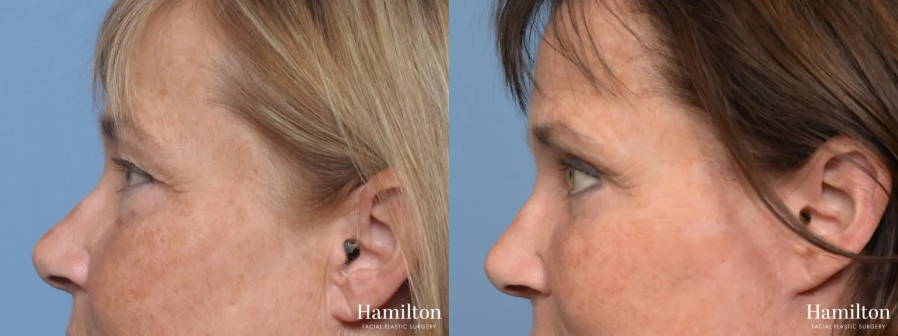 Blepharoplasty: Patient 12 - Before and After 5