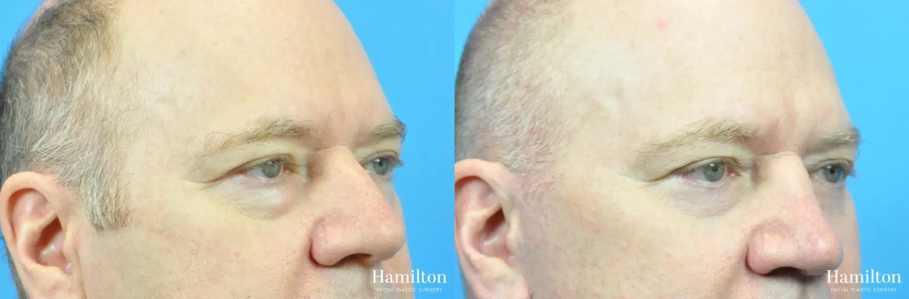 Blepharoplasty: Patient 1 - Before and After 3