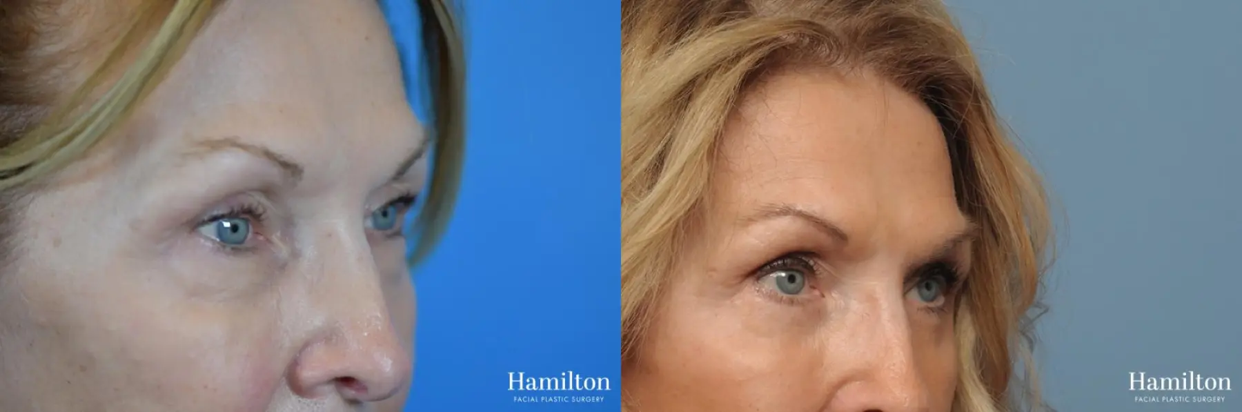 Blepharoplasty: Patient 5 - Before and After 5