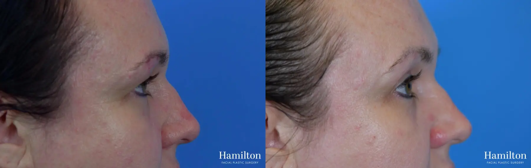 Blepharoplasty: Patient 16 - Before and After 3
