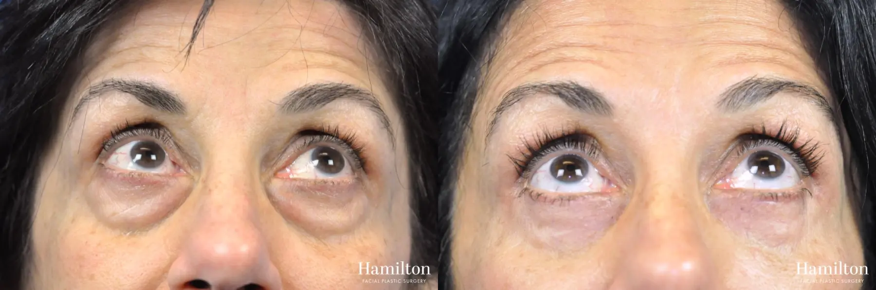 Blepharoplasty: Patient 19 - Before and After 1