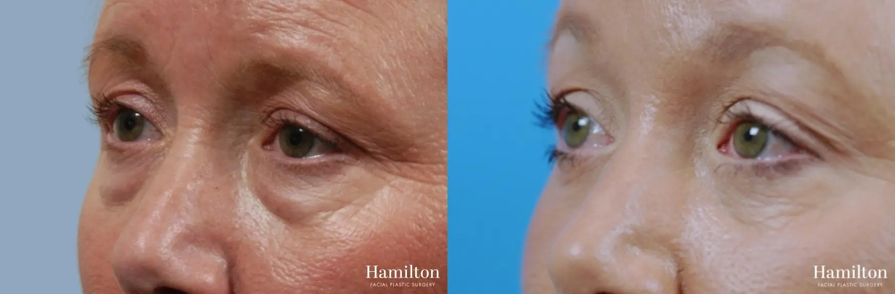Blepharoplasty: Patient 26 - Before and After 3