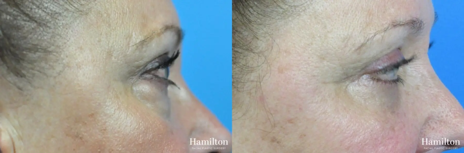 Blepharoplasty: Patient 9 - Before and After 2