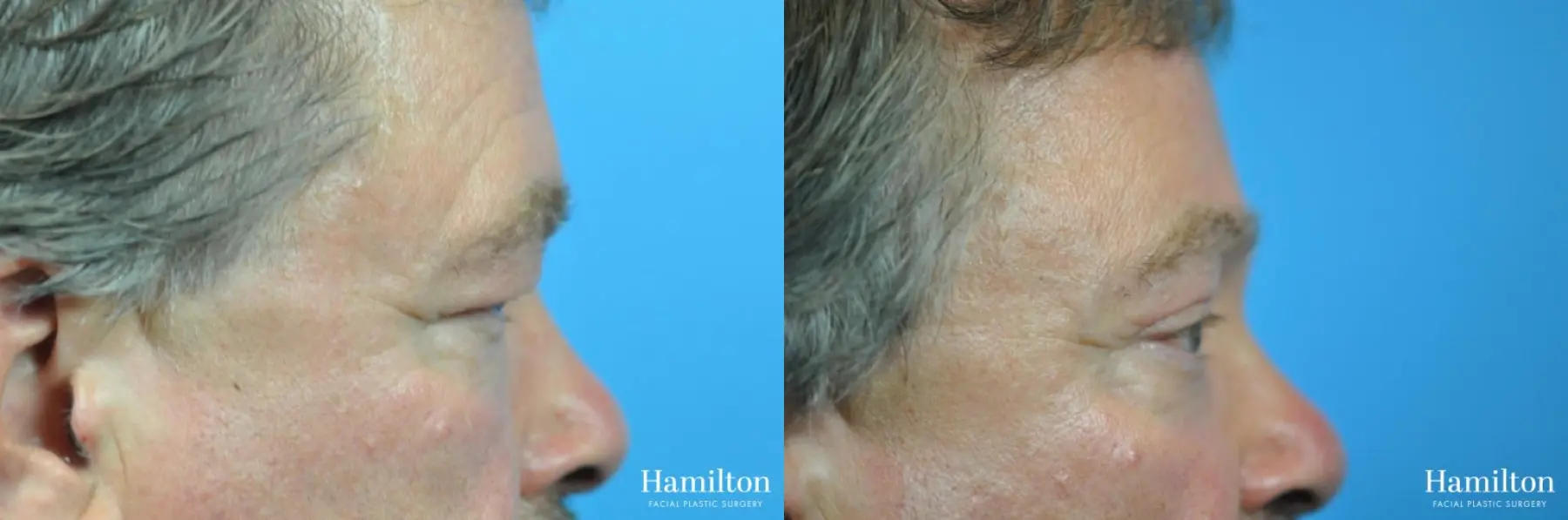 Blepharoplasty: Patient 17 - Before and After 5