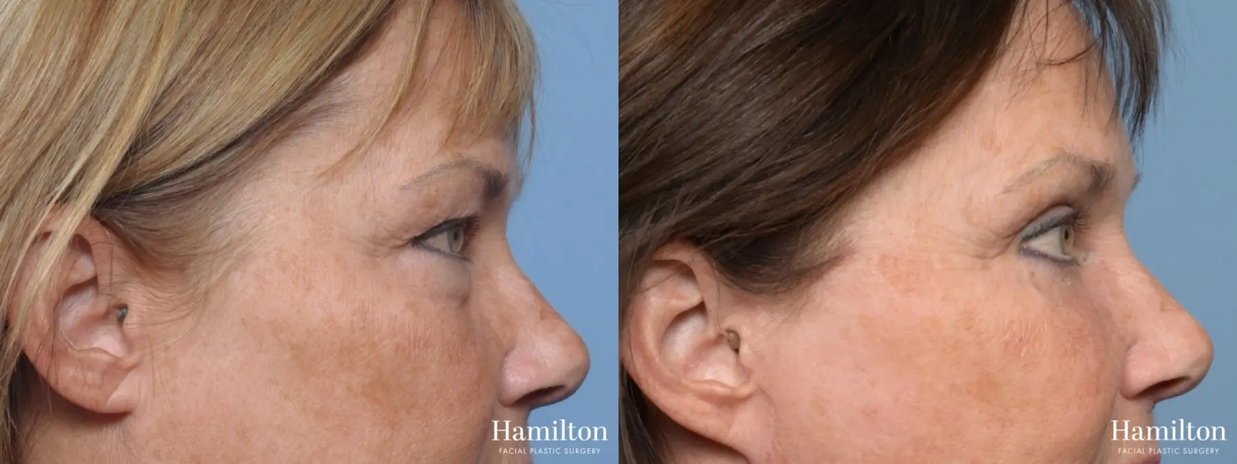 Blepharoplasty: Patient 12 - Before and After 4