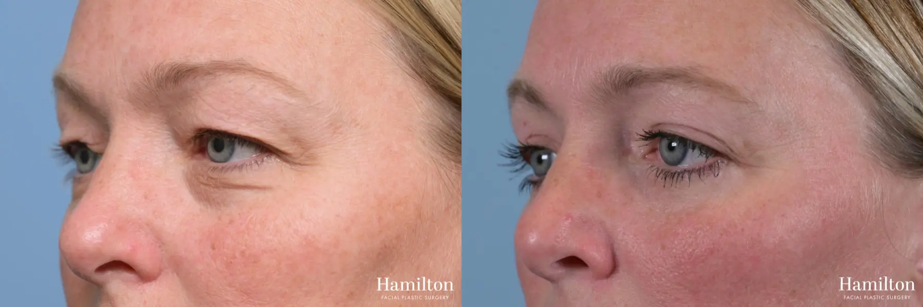 Blepharoplasty: Patient 2 - Before and After 5