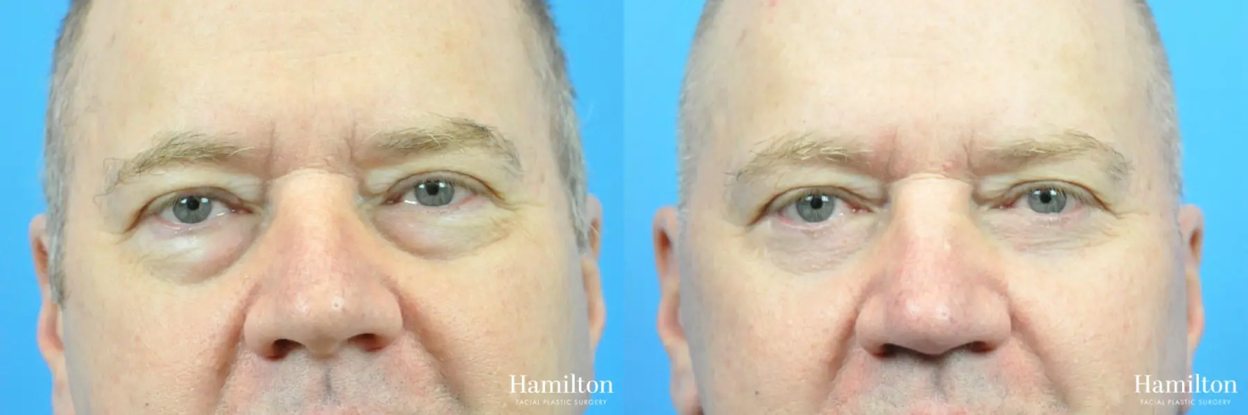 Blepharoplasty: Patient 1 - Before and After 1