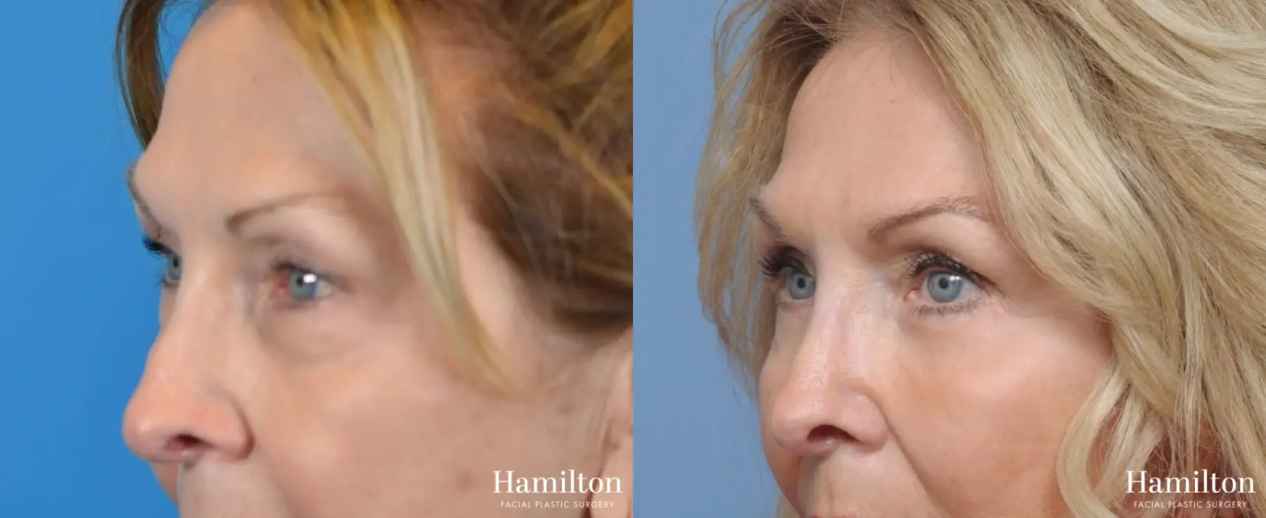 Blepharoplasty: Patient 3 - Before and After 4