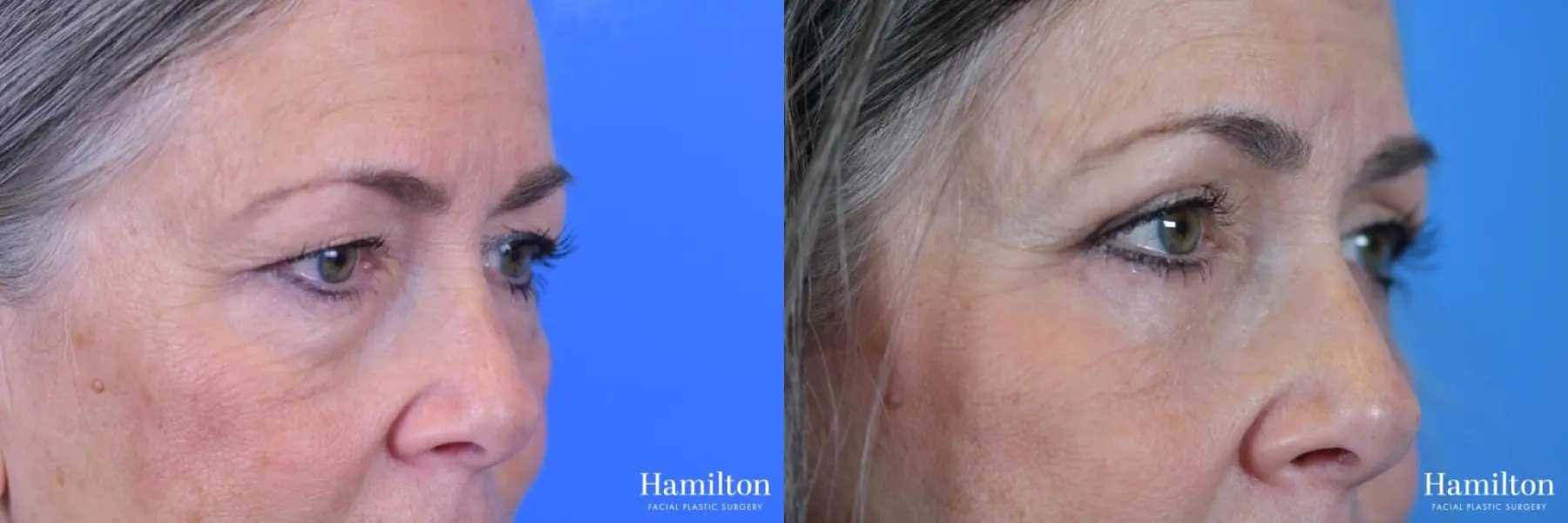 Blepharoplasty: Patient 6 - Before and After 2