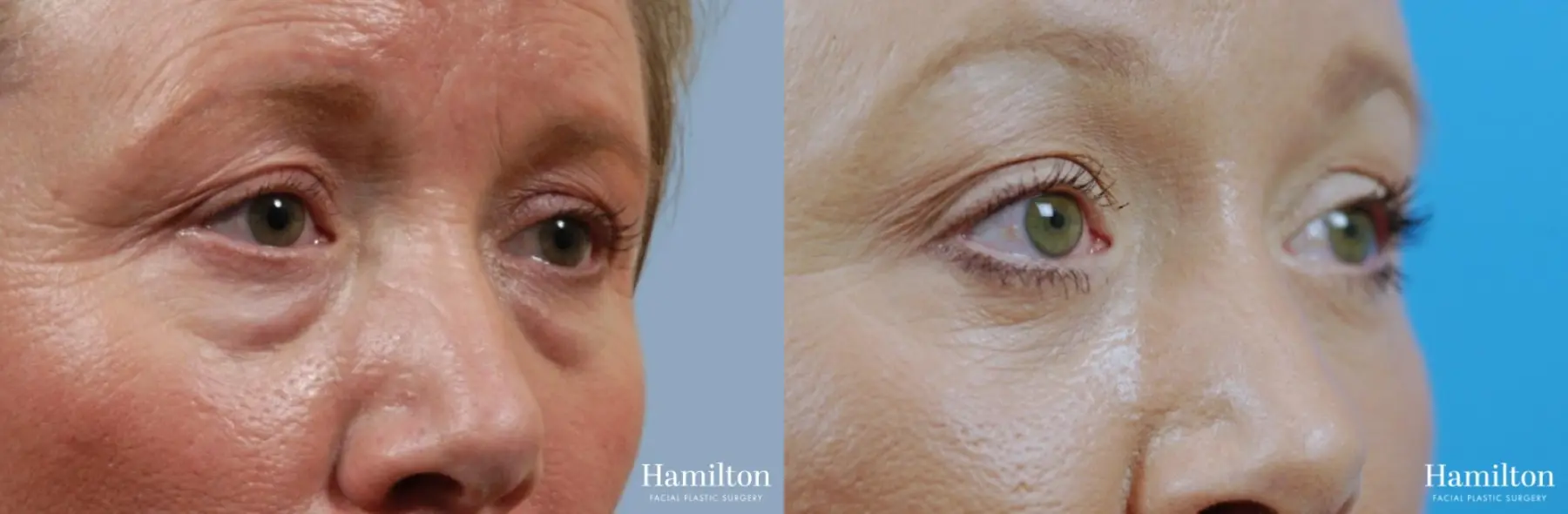 Blepharoplasty: Patient 26 - Before and After 2
