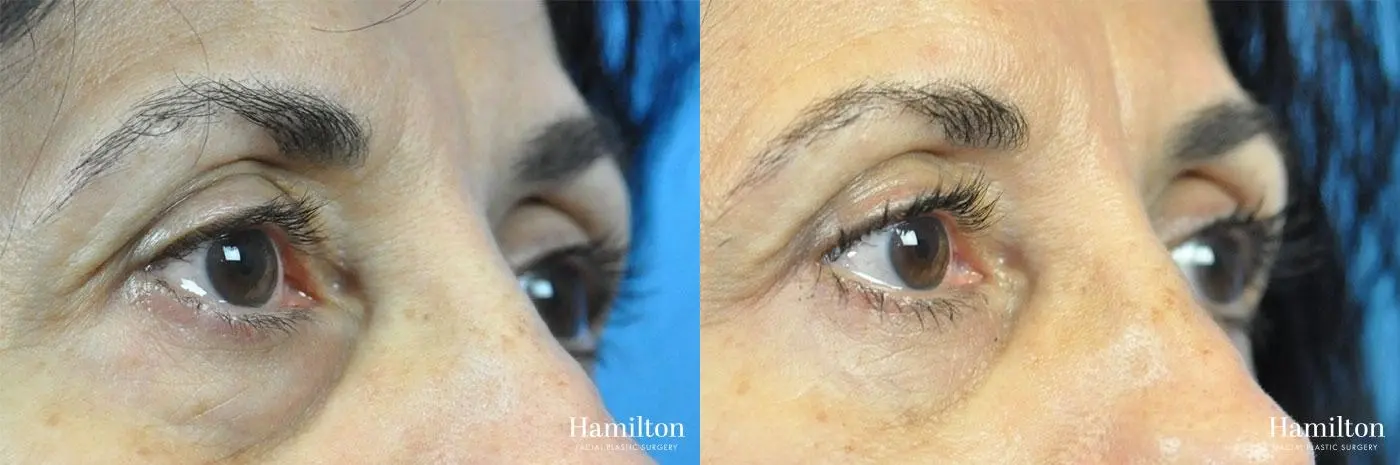 Blepharoplasty: Patient 10 - Before and After 4
