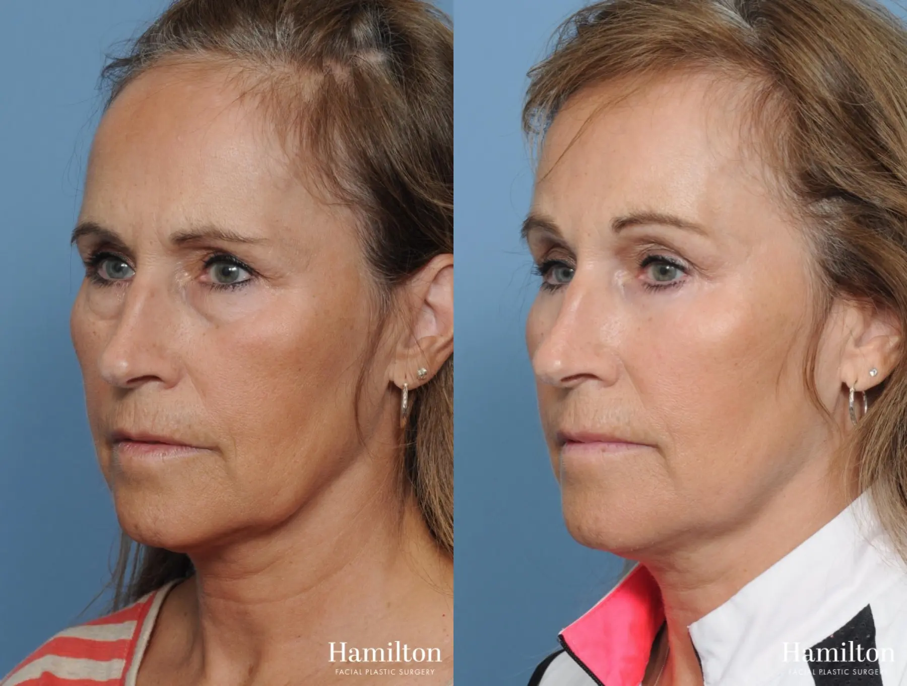 Blepharoplasty: Patient 7 - Before and After 5