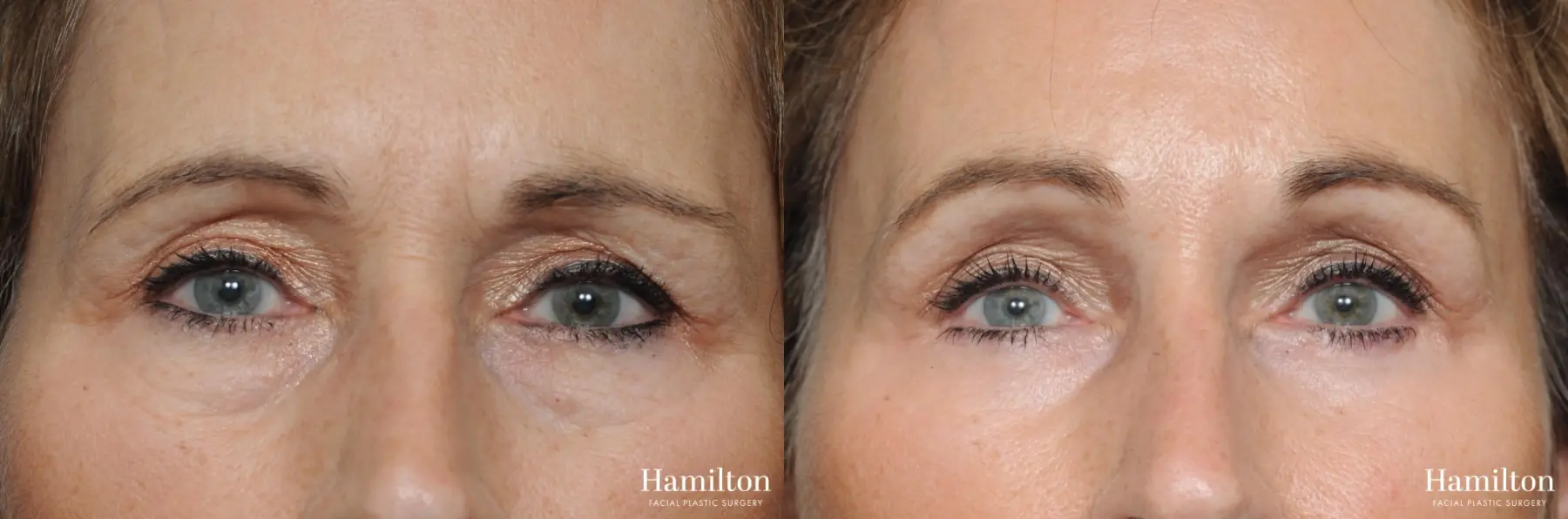 Blepharoplasty: Patient 7 - Before and After 2