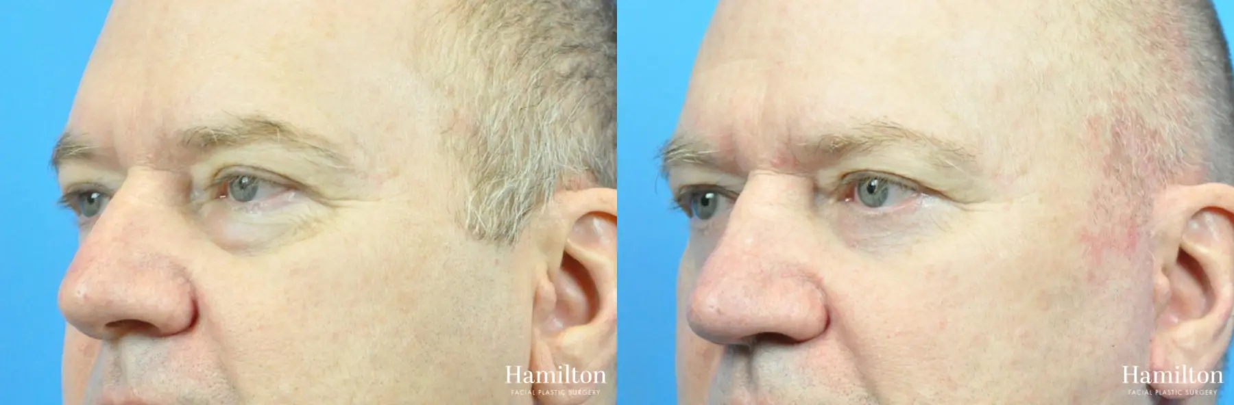 Blepharoplasty: Patient 22 - Before and After 2