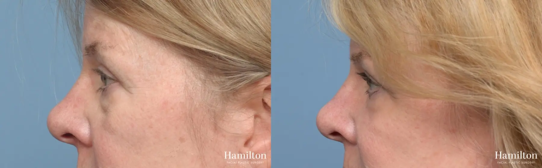 Blepharoplasty: Patient 11 - Before and After 5