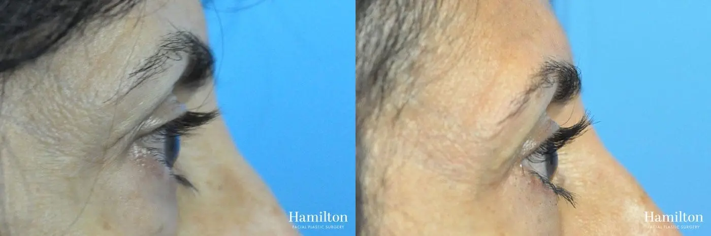 Blepharoplasty: Patient 10 - Before and After 5