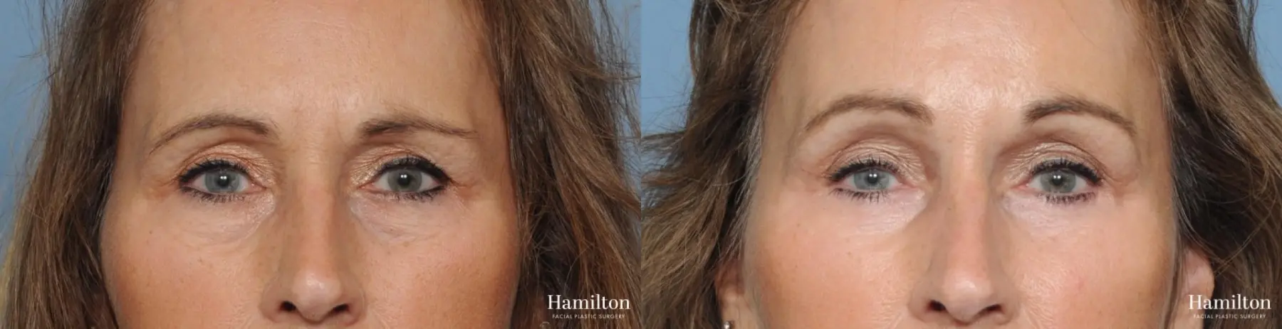 Blepharoplasty: Patient 33 - Before and After 1
