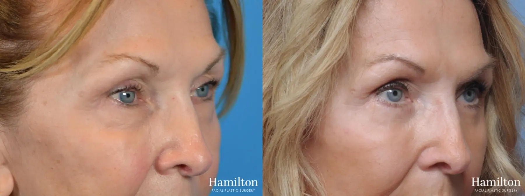 Blepharoplasty: Patient 3 - Before and After 3