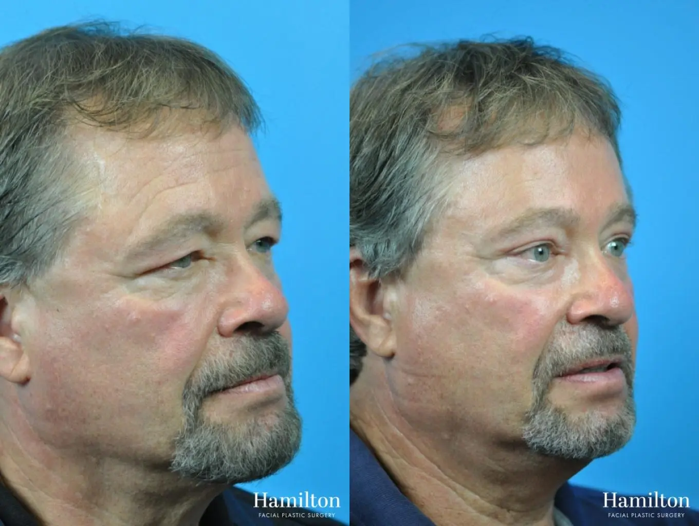 Blepharoplasty: Patient 17 - Before and After 2