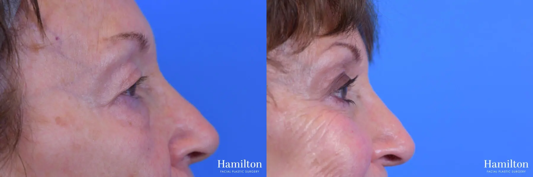 Blepharoplasty: Patient 8 - Before and After 3