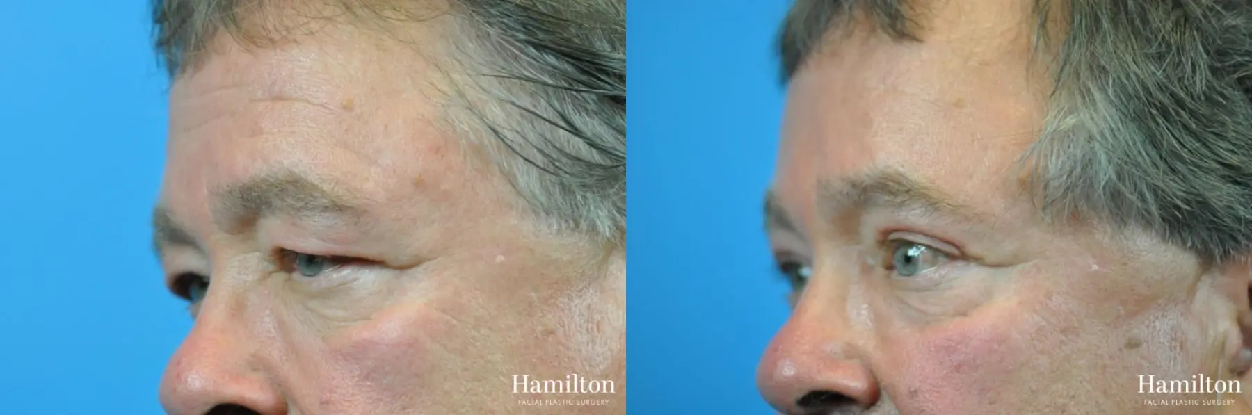 Blepharoplasty: Patient 17 - Before and After 6