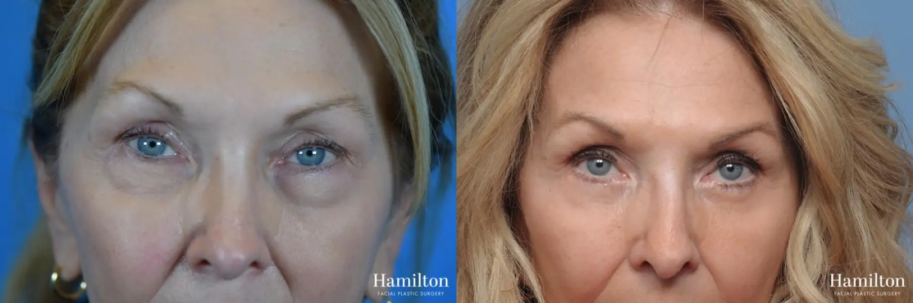 Blepharoplasty: Patient 5 - Before and After 1