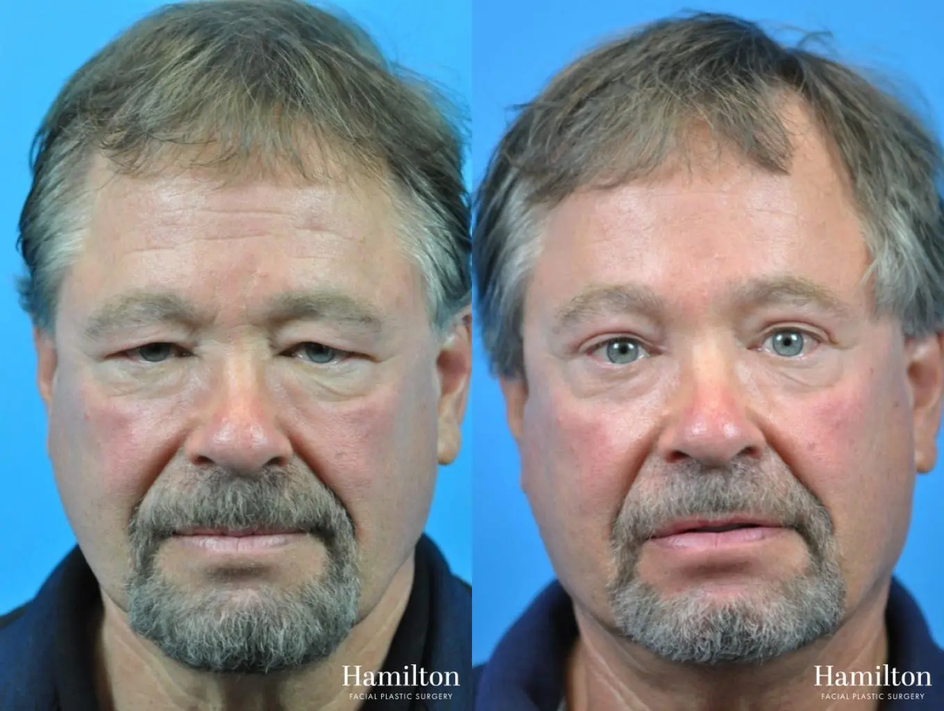 Blepharoplasty: Patient 4 - Before and After  